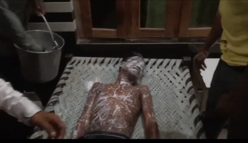 लक्सर में पटाखा विवाद: पड़ोसी ने 18 वर्षीय युवक पर फेंका तेजाब, गांव में तनाव